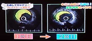 ためしてガッテン コレステロールを下げる方法