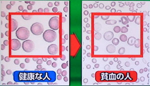 貧血が原因で起こる怖い症状-ほんまでっかTV