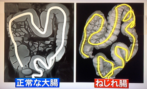 便秘の原因はねじれ腸かも？解消法（はなまるマーケットより）