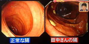 便秘の原因はねじれ腸かも？解消法（はなまるマーケットより）